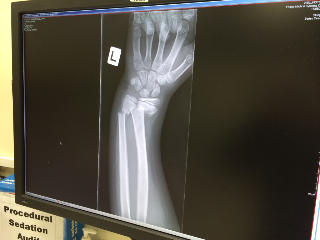 The 11-year-old breaks his arm coming off a mountain bike. Pretty impressive.